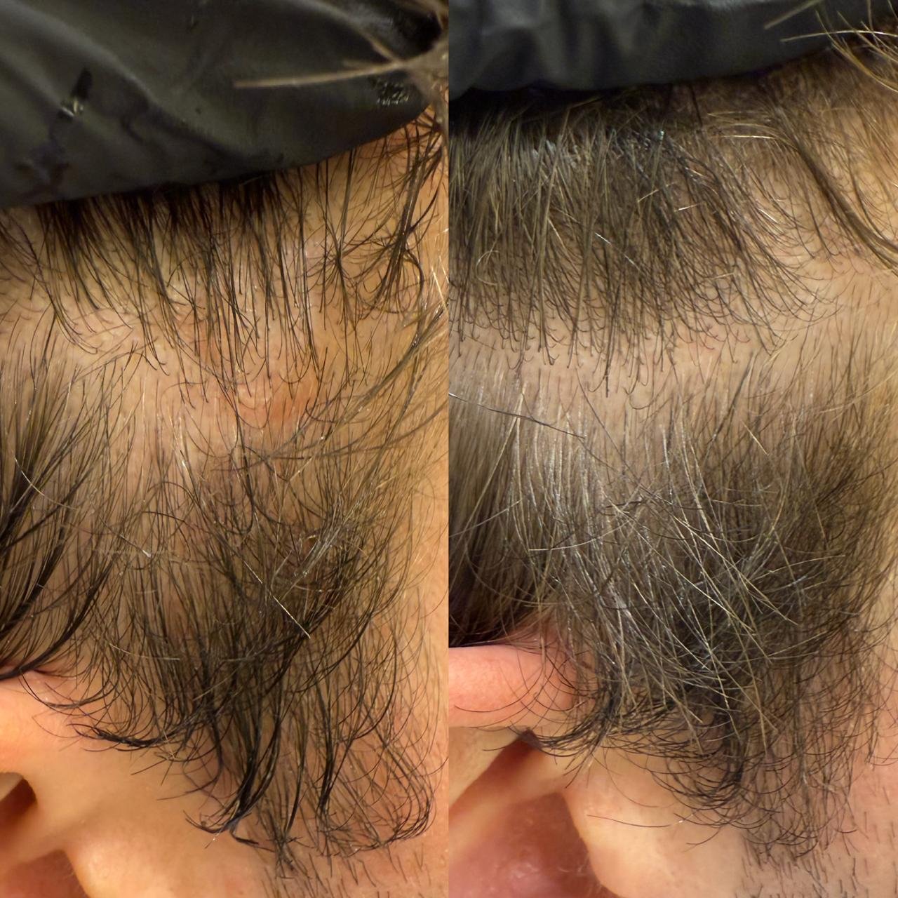 Before and after Sensi Scalp hair treatment