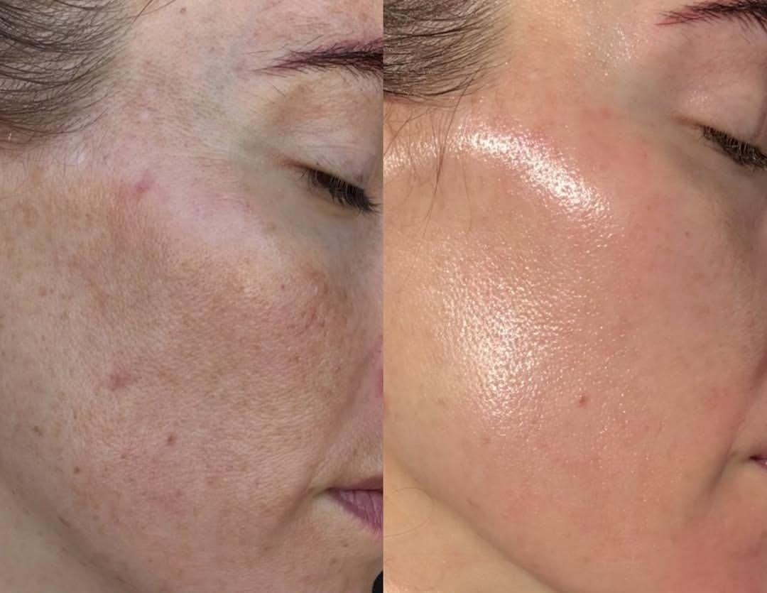 Before and after Peel Perfection facial treatment